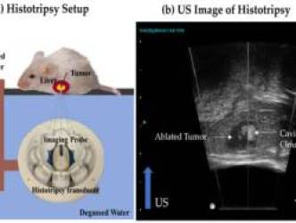 Một kỹ thuật siêu âm giúp đánh tan khối u ung thư gan mà không cần phẫu thuật